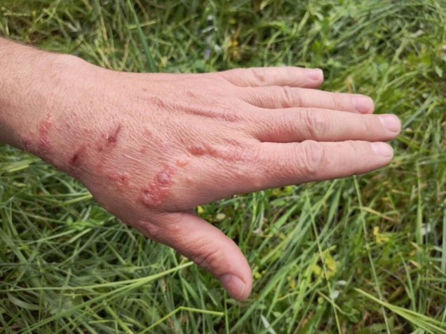 First degree burn of skin, closeup. Burns of hand, wounds. Influence poison of  Heracleum (Giant Hogweed, Cow parsnip) on skin. One week after defeat poison